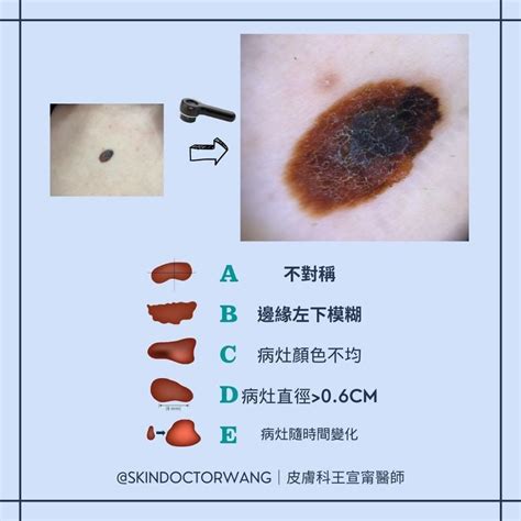 陰莖長黑痣|陰莖長黑痣 要找皮膚科｜性福教戰｜性愛｜元氣